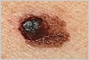melanoma dermatologist jupiter fl