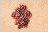 melanoma dermatologist jupiter fl