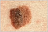 melanoma dermatologist jupiter fl