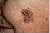 melanoma dermatologist jupiter fl