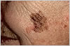 melanoma_diameter melanoma dermatologist jupiter fl