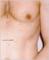 melanoma dermatologist jupiter fl