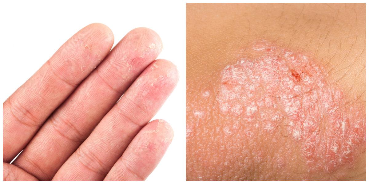 Eczema Psoriasis doctor