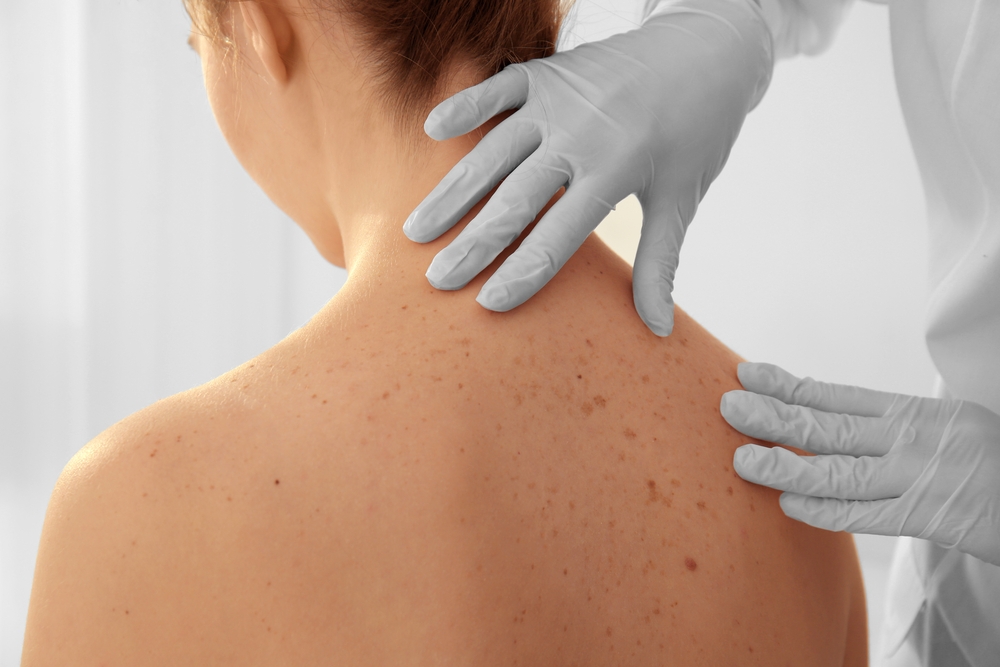 skin screening dermatologist jupiter fl