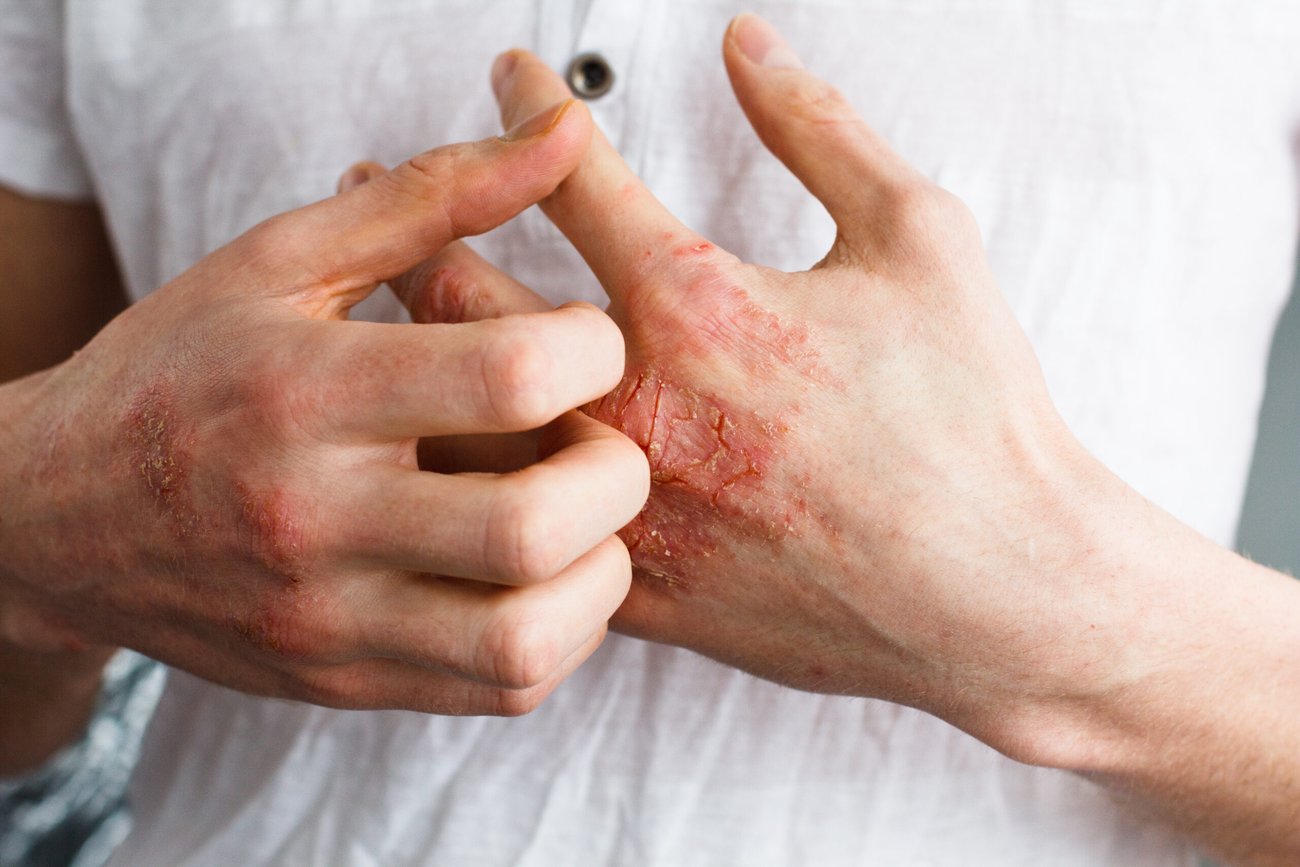 How to Manage Eczema