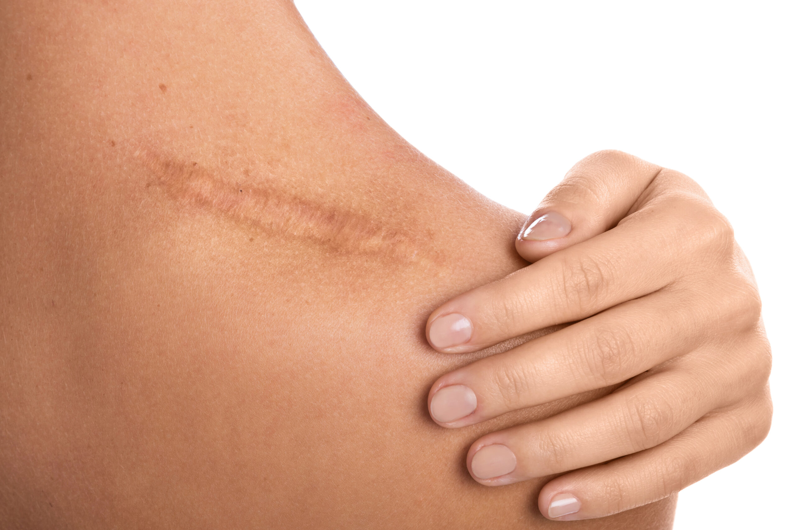 Psoriasis Spotting and Scarring: How to Cope