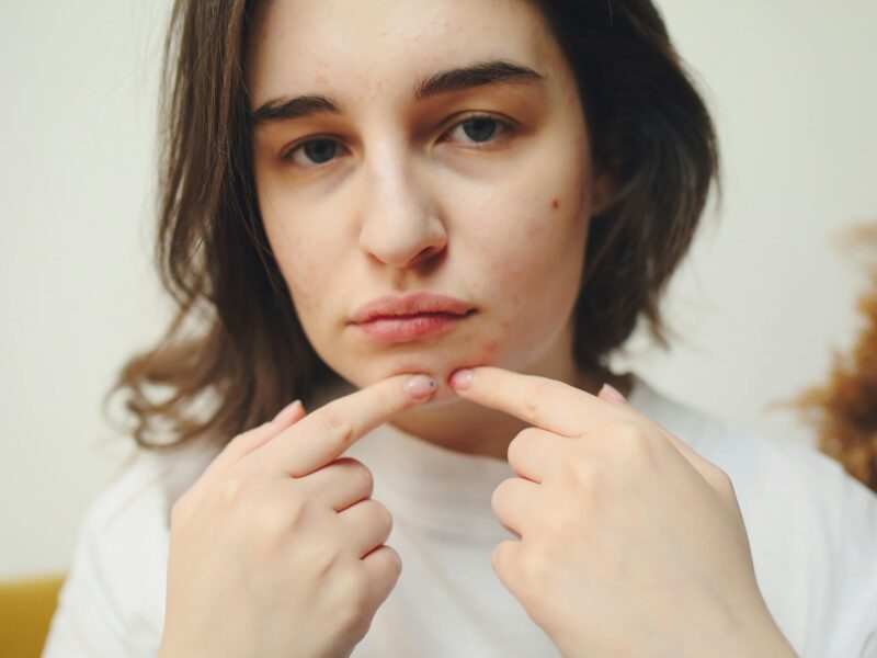 adult acne on jawline hormonal acne treatment options